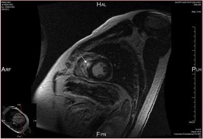 Cardiac sarcoidosis: diagnosis and management